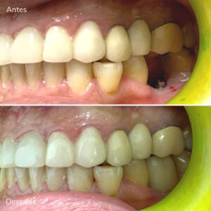 Sonrisa restaurada después del tratamiento con implante dental Neodent en Zudents Clinic