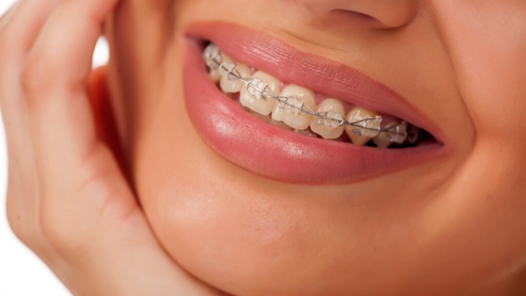 Cuidar tus brackets