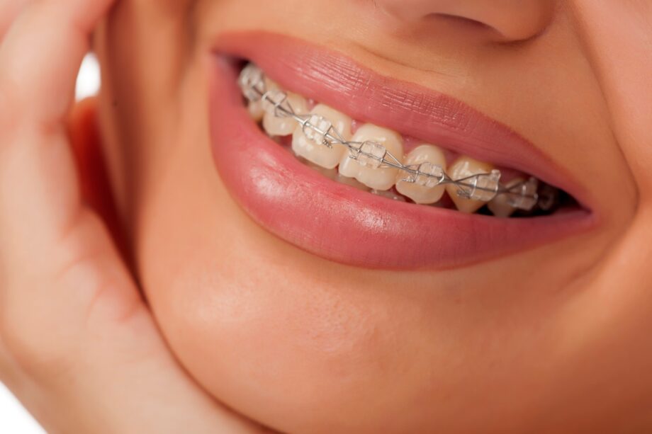 Cuidar tus brackets
