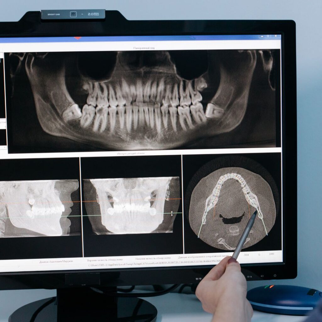 Resultado de un CBCT